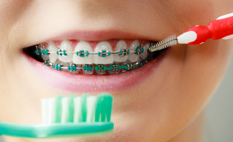 orthodontics braces-big